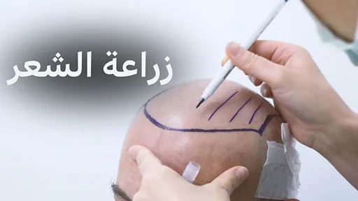 كيف تتم زراعة الشعر وما هي أضرارها؟